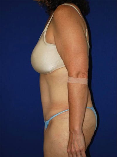 Abdominoplasty Before & After Gallery - Patient 175169149 - Image 2