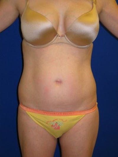 Mommy Makeover Before & After Gallery - Patient 175169160 - Image 1