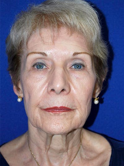 Facelift Before & After Gallery - Patient 175169158 - Image 1