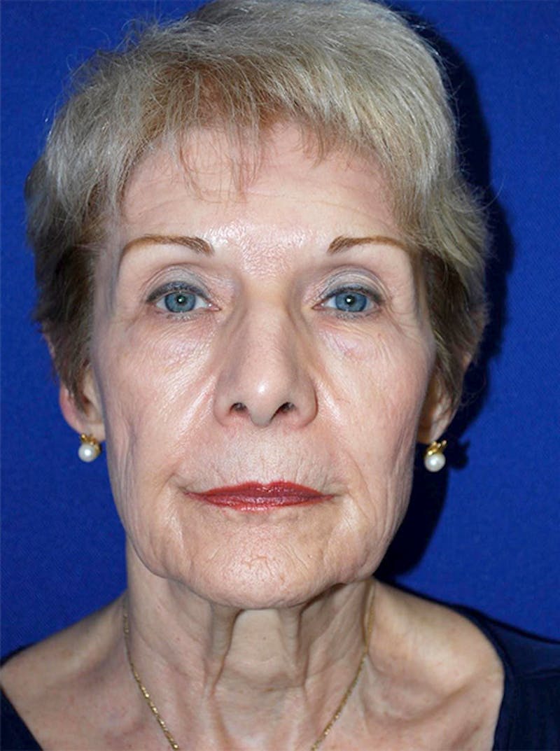 Facelift Before & After Gallery - Patient 175169158 - Image 1