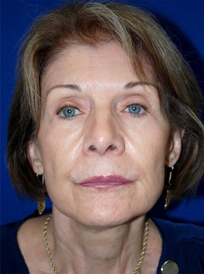 Facelift Before & After Gallery - Patient 175169158 - Image 2