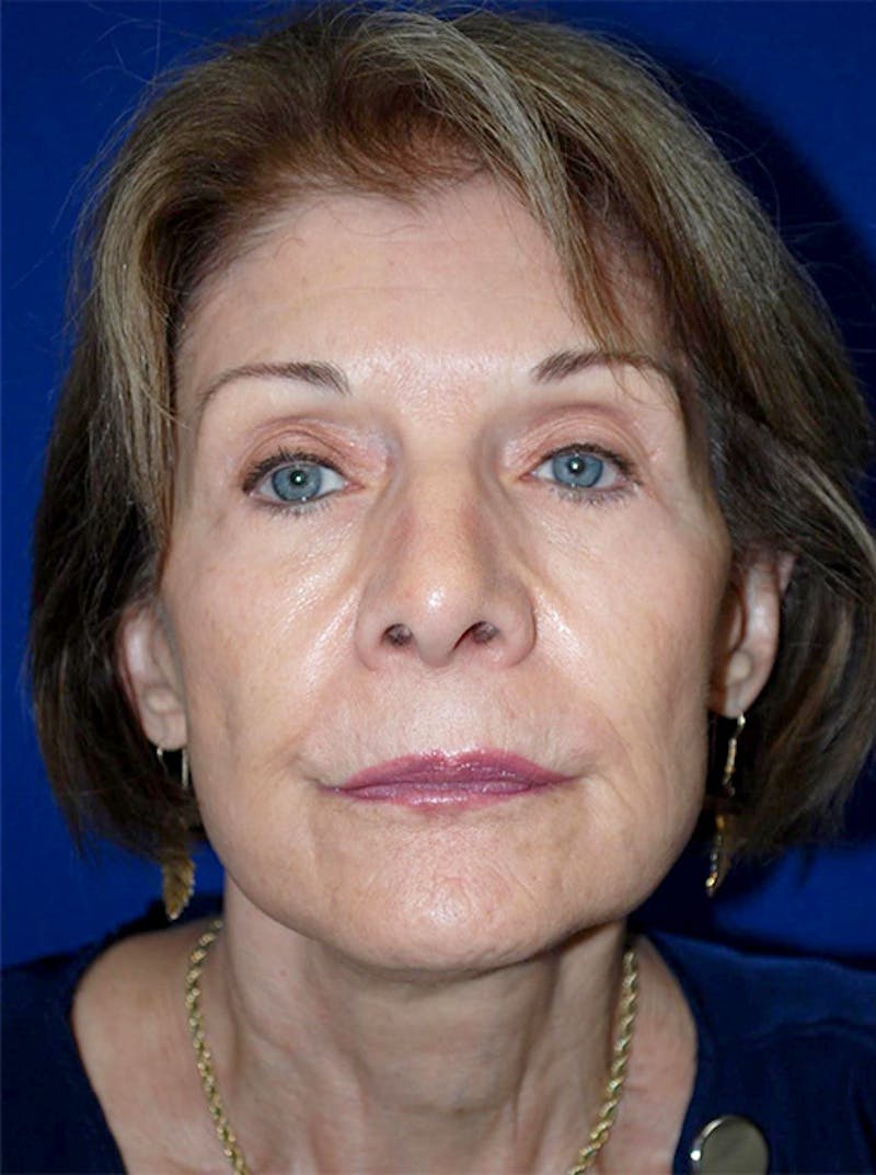 Facelift Before & After Gallery - Patient 175169158 - Image 2