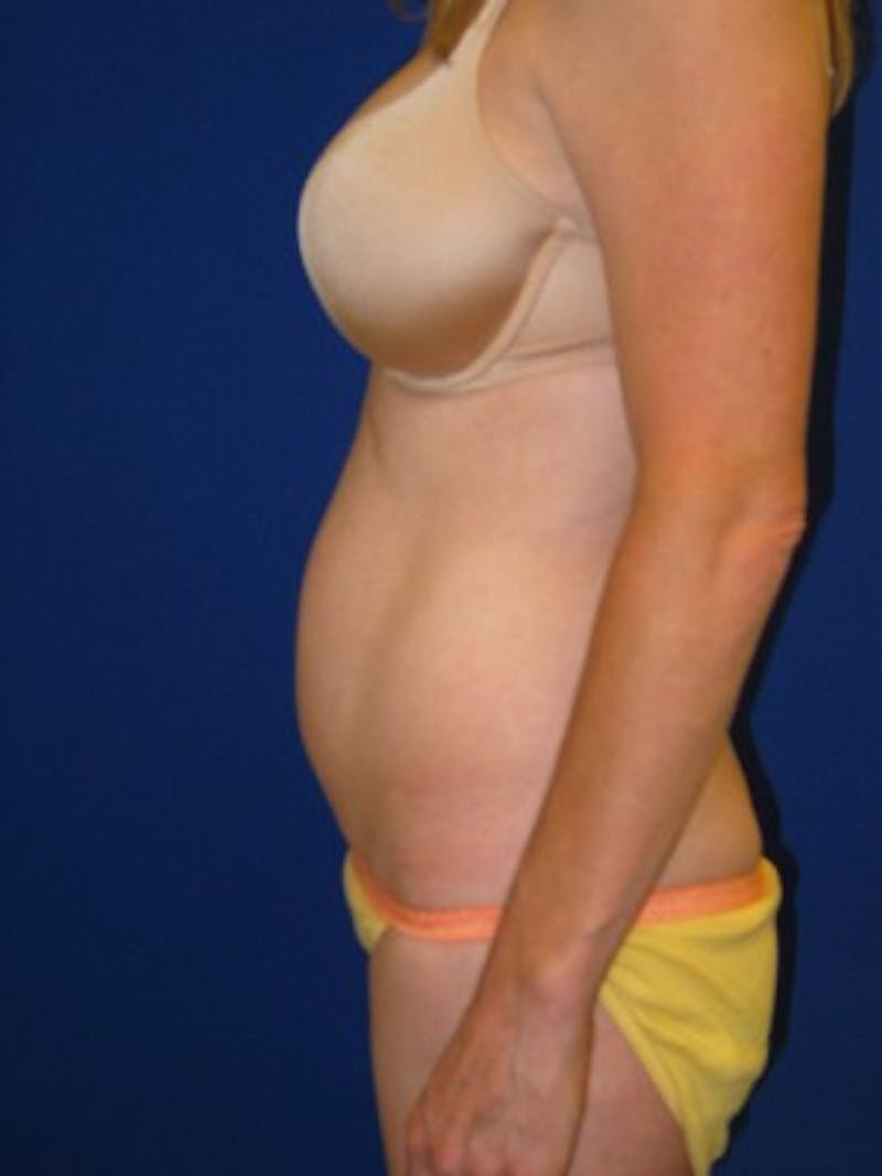 Mommy Makeover Before & After Gallery - Patient 175169160 - Image 3