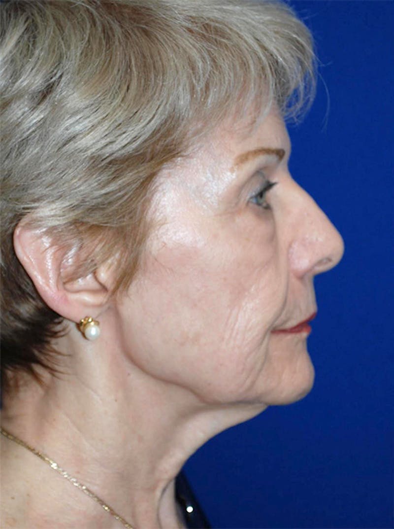 Facelift Before & After Gallery - Patient 175169158 - Image 3