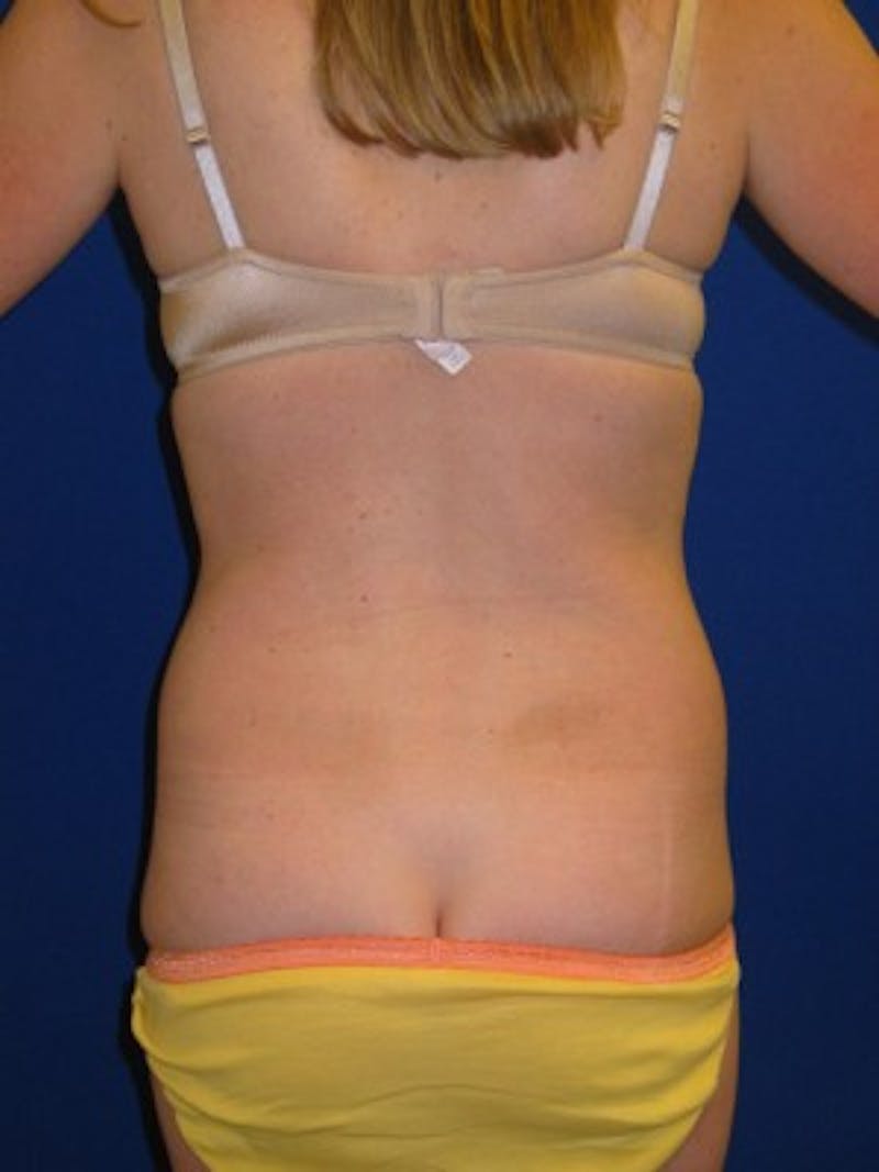 Mommy Makeover Before & After Gallery - Patient 175169160 - Image 5