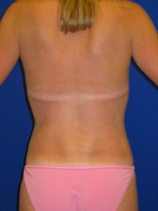 Mommy Makeover Before & After Gallery - Patient 175169160 - Image 6