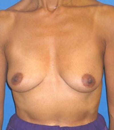 Mastopexy/Lift Before & After Gallery - Patient 175169164 - Image 1