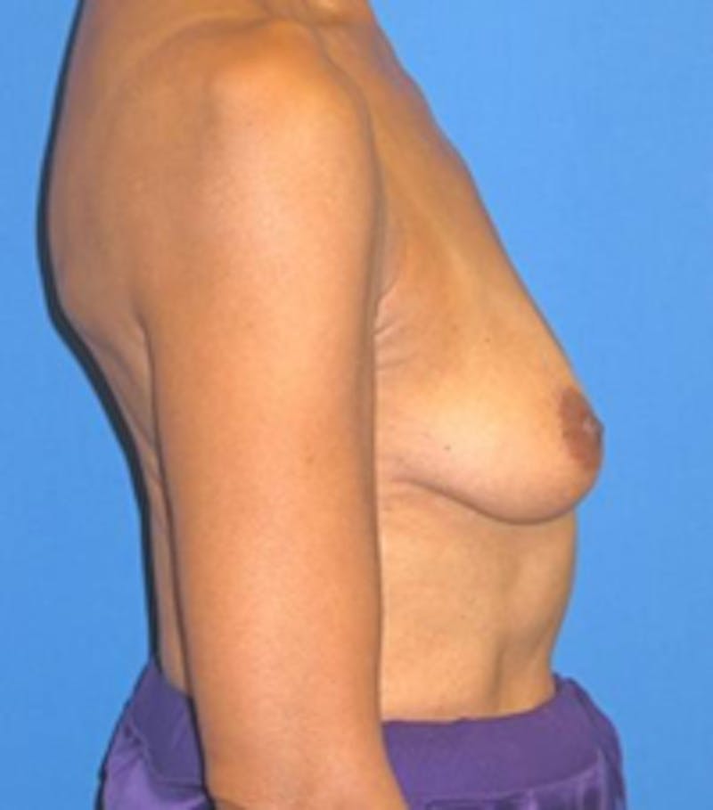 Mastopexy/Lift Before & After Gallery - Patient 175169164 - Image 3