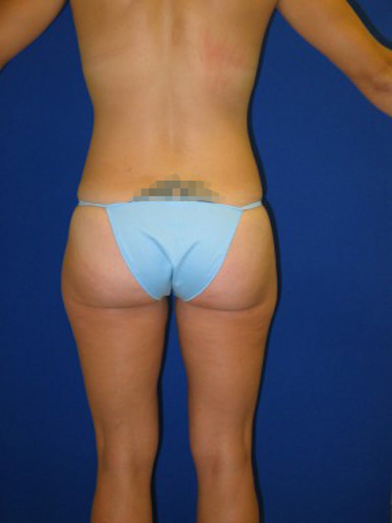Liposuction Before & After Gallery - Patient 175169165 - Image 4