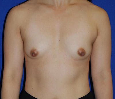 Augmentation Before & After Gallery - Patient 175169273 - Image 1