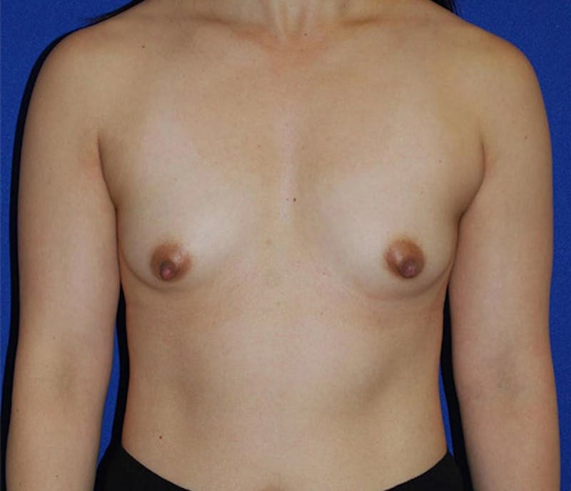Augmentation Before & After Gallery - Patient 175169273 - Image 1