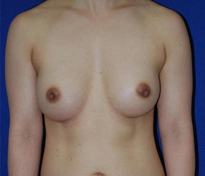 Augmentation Before & After Gallery - Patient 175169273 - Image 2