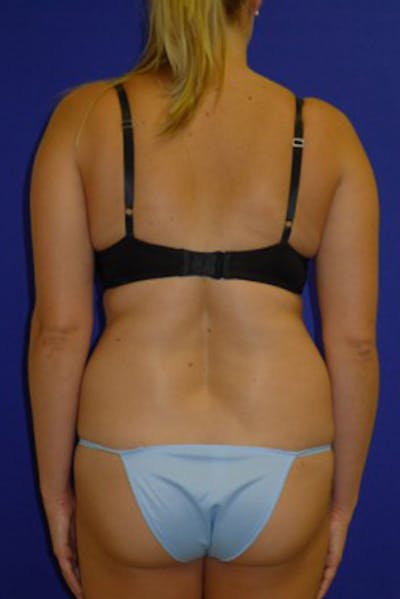 Liposuction Before & After Gallery - Patient 175169276 - Image 1
