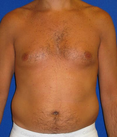 Gynecomastia Before & After Gallery - Patient 175169278 - Image 1