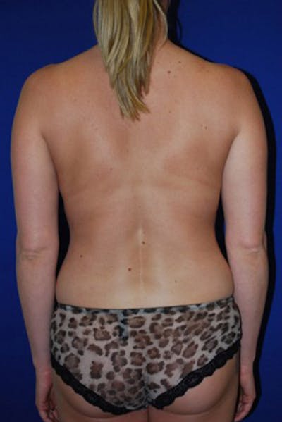 Liposuction Before & After Gallery - Patient 175169276 - Image 2