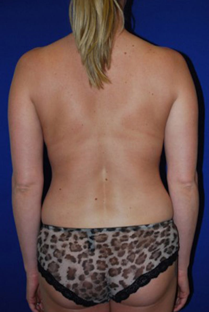 Liposuction Before & After Gallery - Patient 175169276 - Image 2