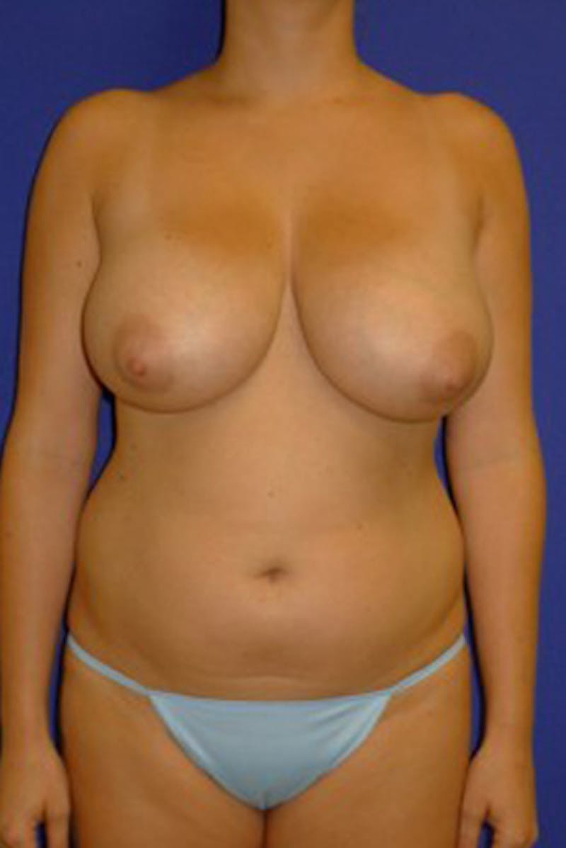 Liposuction Before & After Gallery - Patient 175169276 - Image 3