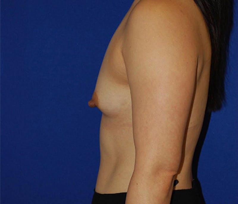 Augmentation Before & After Gallery - Patient 175169273 - Image 5