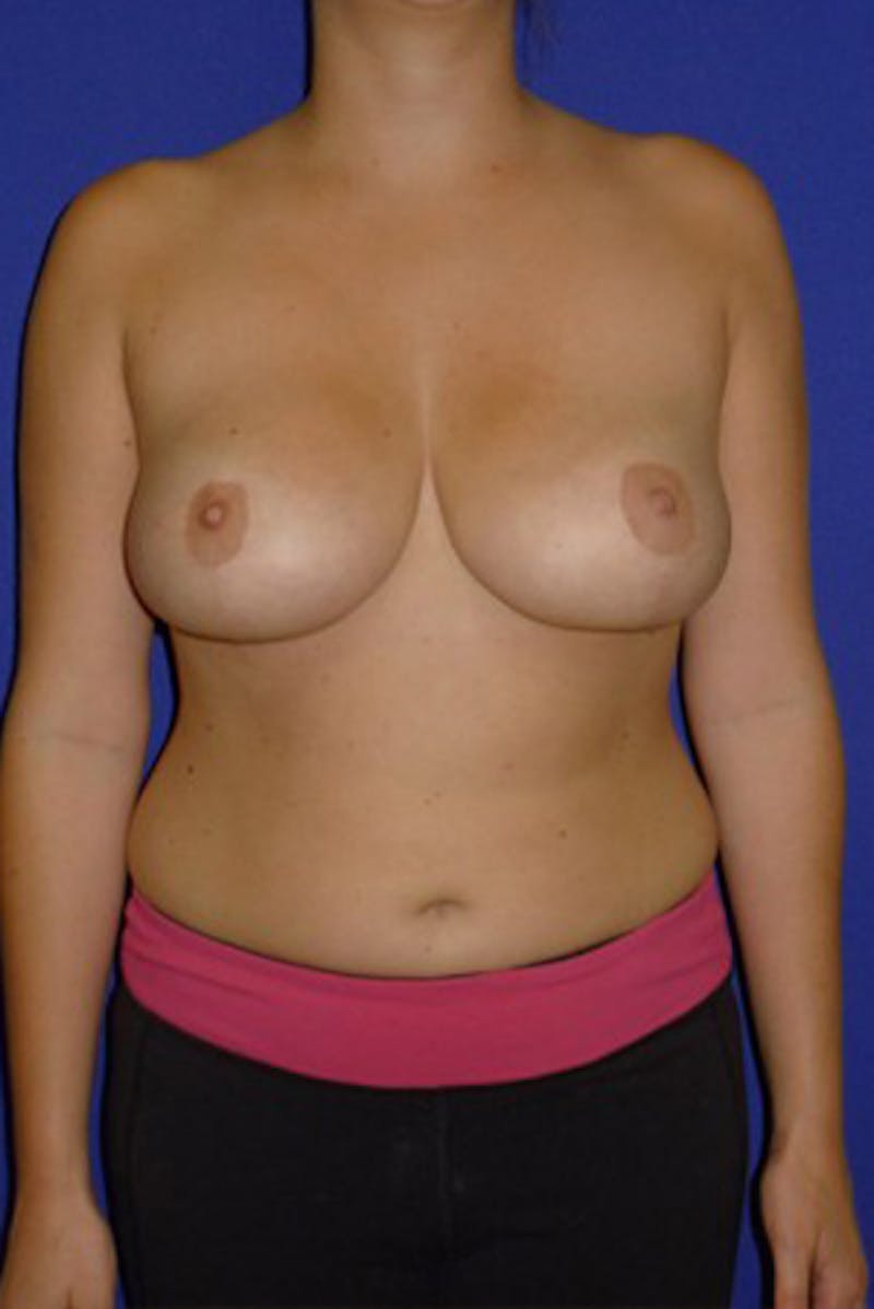 Liposuction Before & After Gallery - Patient 175169276 - Image 4
