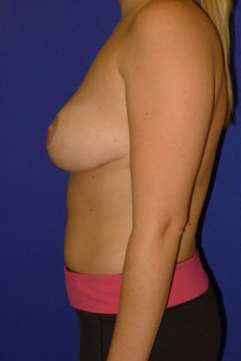 Liposuction Before & After Gallery - Patient 175169276 - Image 6