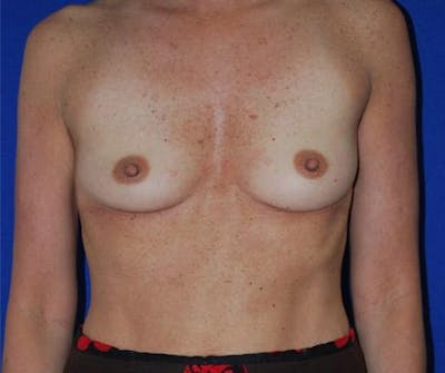 Augmentation Before & After Gallery - Patient 175169285 - Image 1
