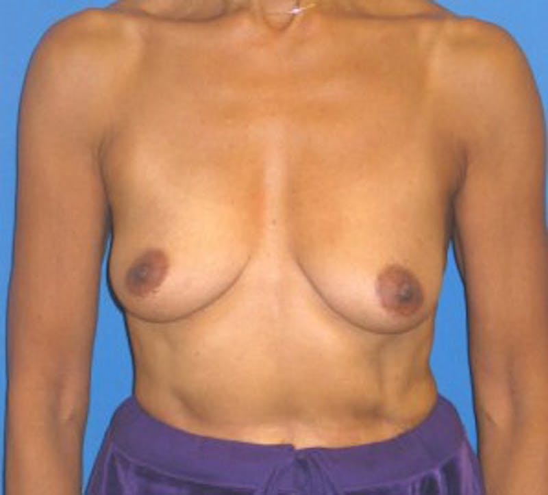 Augmentation Mastopexy Before & After Gallery - Patient 175169284 - Image 1