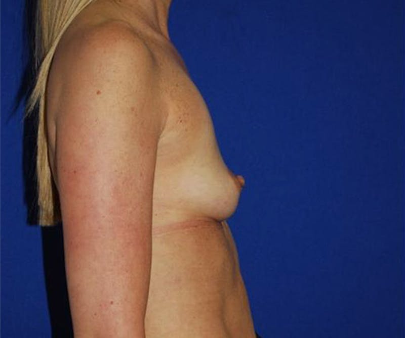 Augmentation Before & After Gallery - Patient 175169285 - Image 3