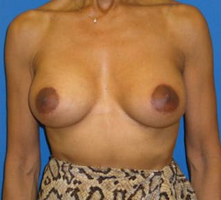 Augmentation Mastopexy Before & After Gallery - Patient 175169284 - Image 2