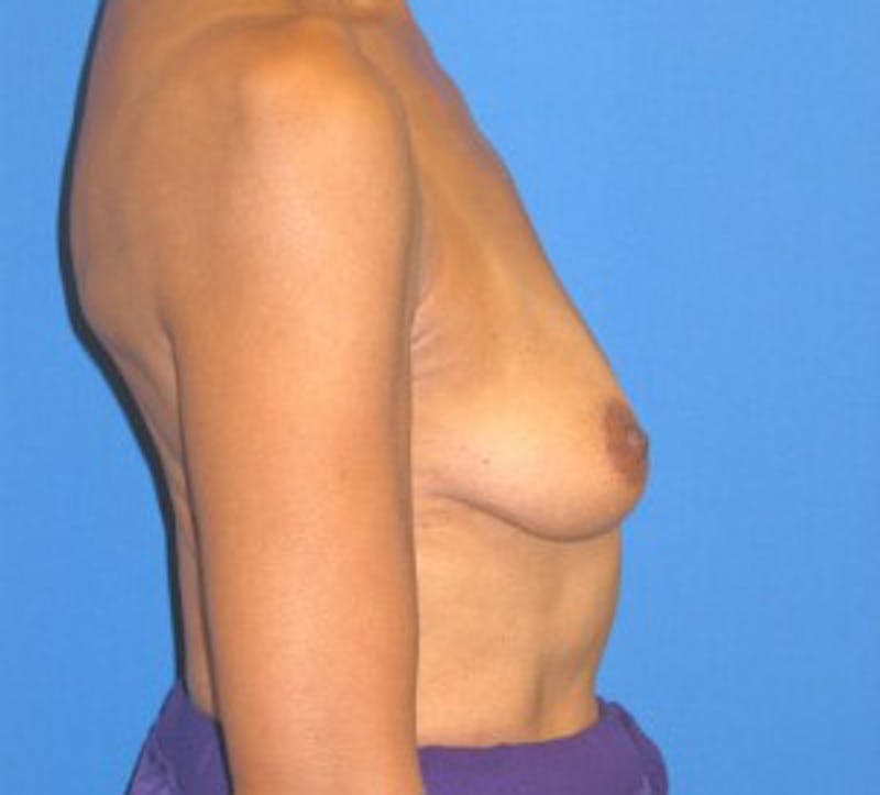 Augmentation Mastopexy Before & After Gallery - Patient 175169284 - Image 3