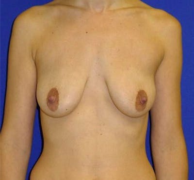 Augmentation Mastopexy Before & After Gallery - Patient 175169295 - Image 1