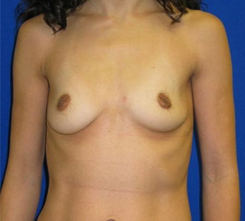 Augmentation Before & After Gallery - Patient 175169290 - Image 1