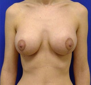 Augmentation Mastopexy Before & After Gallery - Patient 175169295 - Image 2