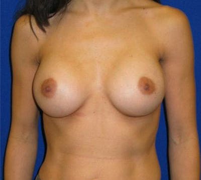 Augmentation Before & After Gallery - Patient 175169290 - Image 2
