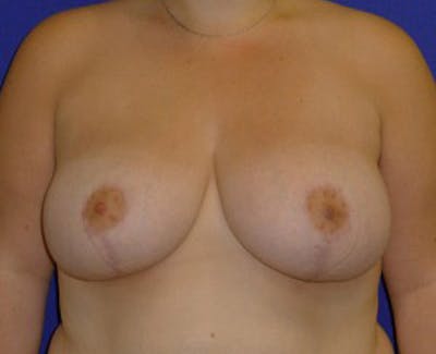 Mastopexy/Lift Before & After Gallery - Patient 175169292 - Image 2