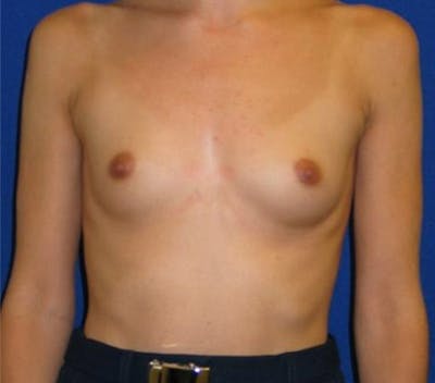 Augmentation Before & After Gallery - Patient 175169302 - Image 1