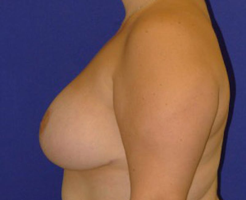 Mastopexy/Lift Before & After Gallery - Patient 175169292 - Image 4