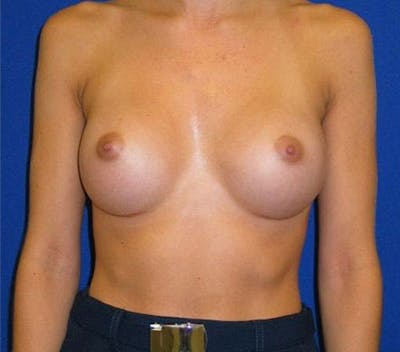 Augmentation Before & After Gallery - Patient 175169302 - Image 2