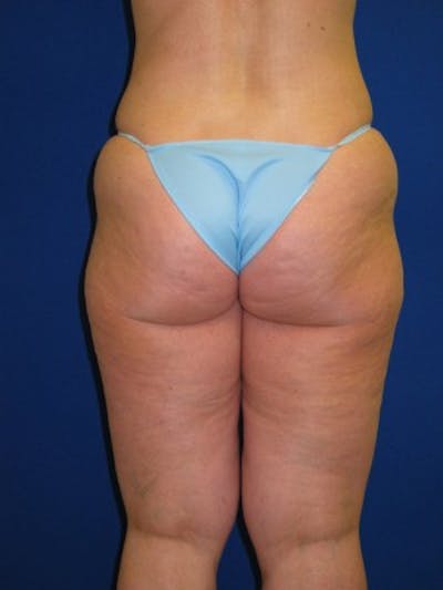 Liposuction Before & After Gallery - Patient 175169301 - Image 1
