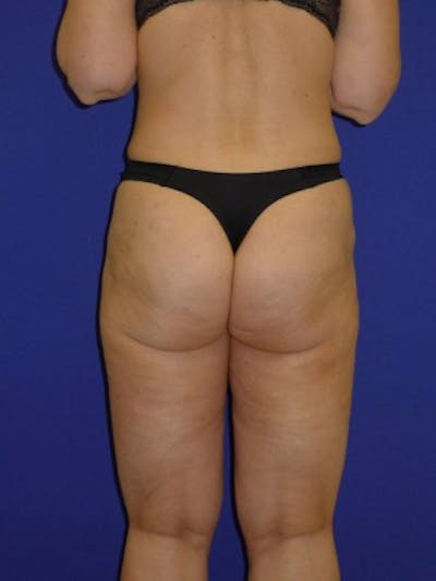 Liposuction Before & After Gallery - Patient 175169301 - Image 2