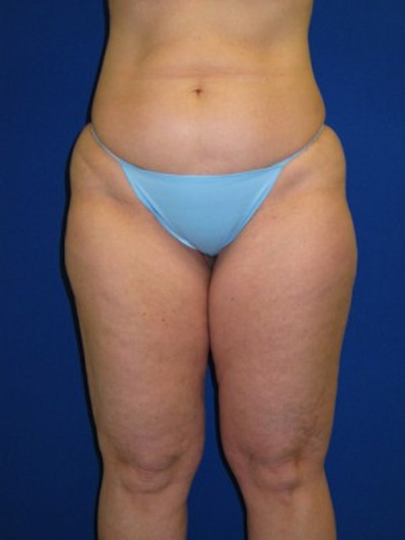 Liposuction Before & After Gallery - Patient 175169301 - Image 3