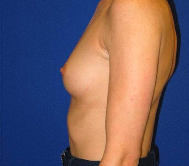 Augmentation Before & After Gallery - Patient 175169302 - Image 5