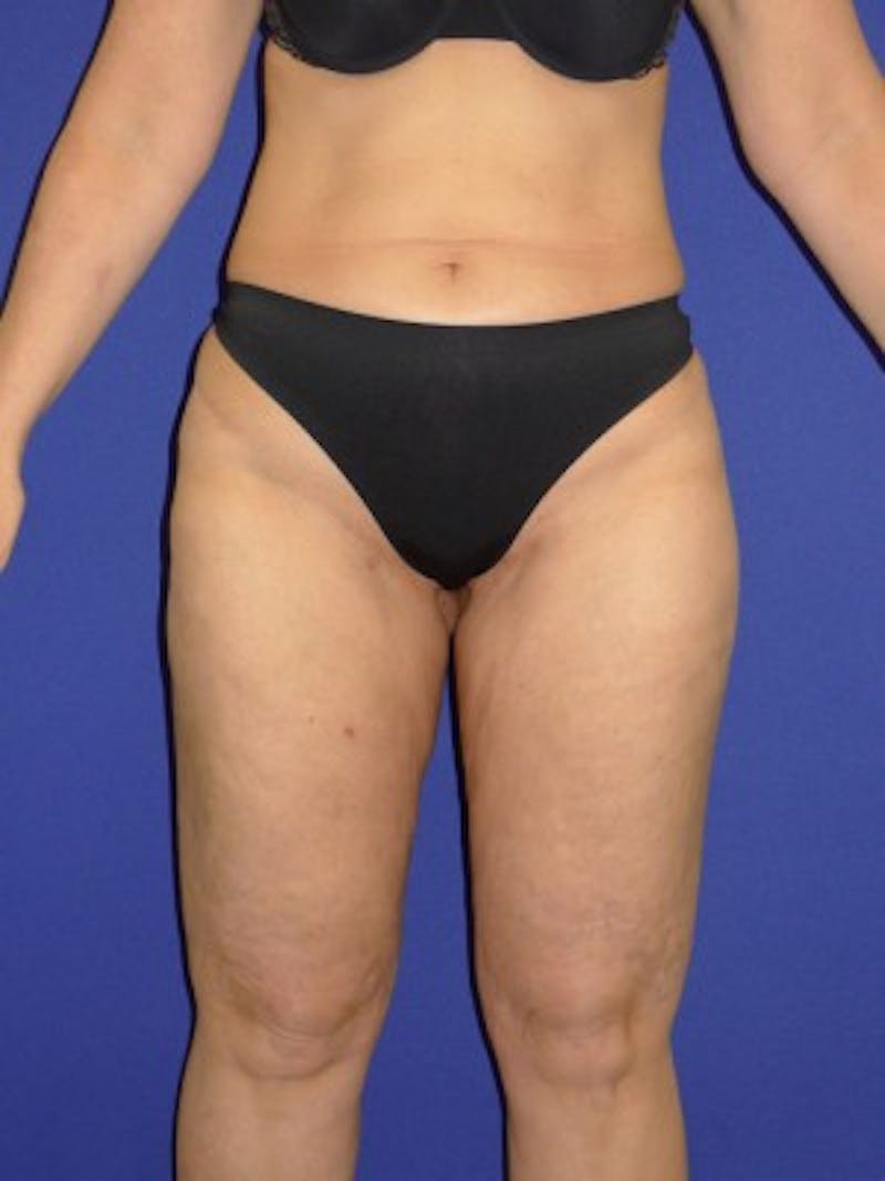 Liposuction Before & After Gallery - Patient 175169301 - Image 4