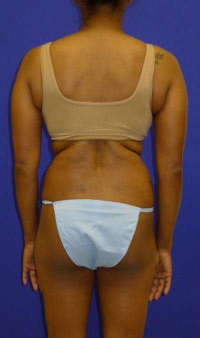 Liposuction Before & After Gallery - Patient 175169309 - Image 1