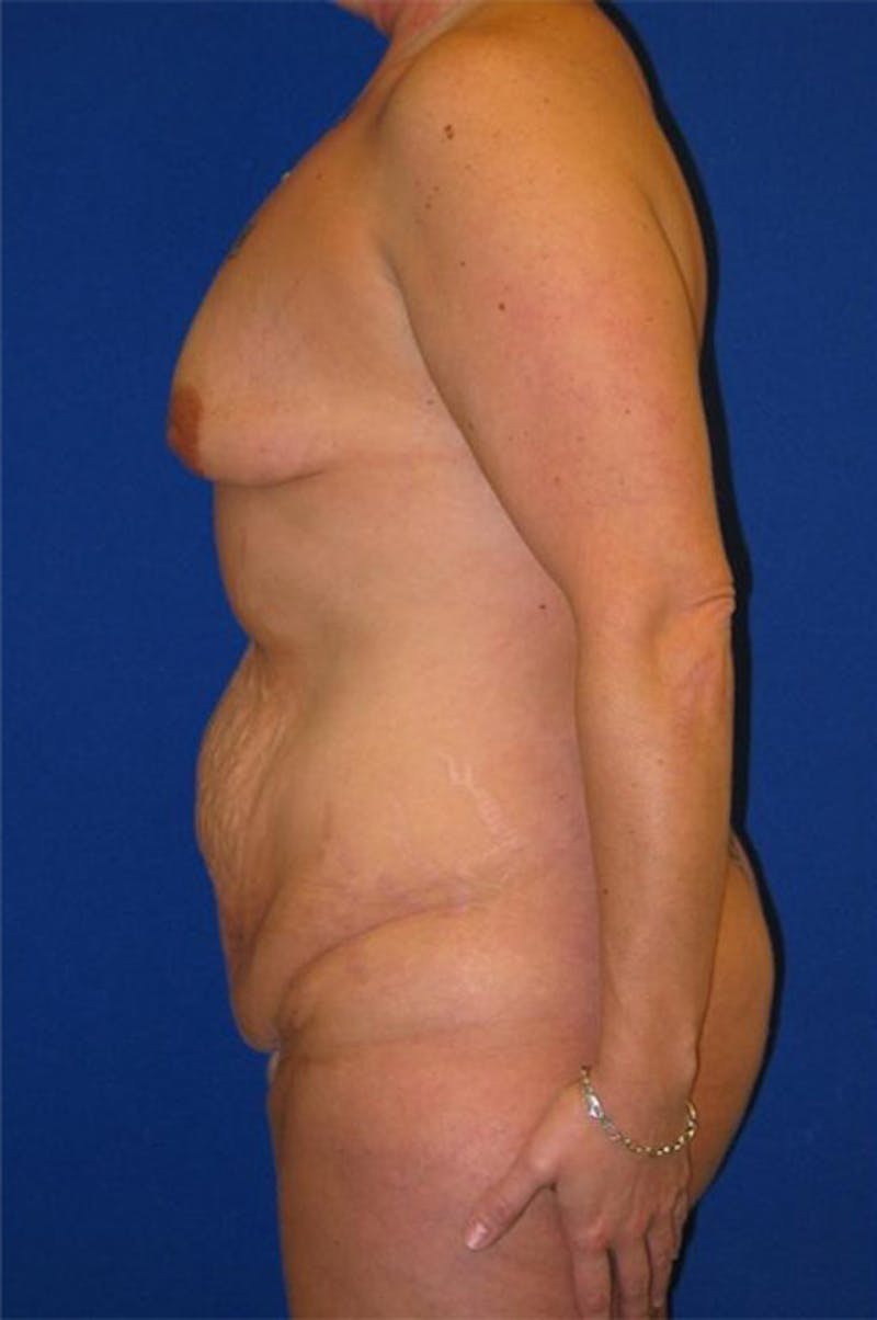 Extended Abdominoplasty Before & After Gallery - Patient 175169319 - Image 3