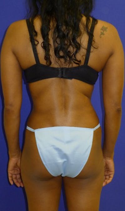 Liposuction Before & After Gallery - Patient 175169309 - Image 2
