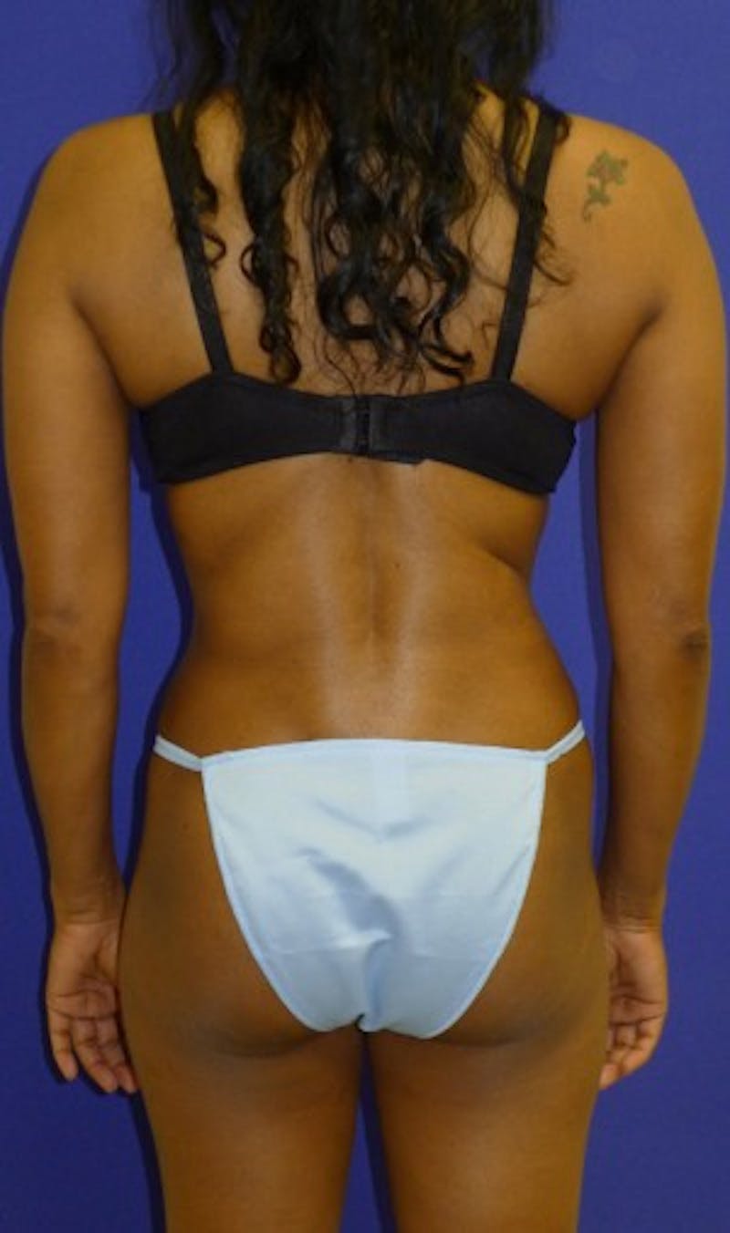 Liposuction Before & After Gallery - Patient 175169309 - Image 2