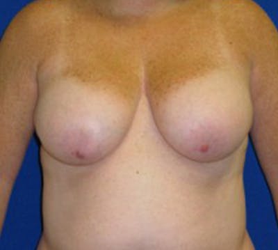 Mastopexy/Lift Before & After Gallery - Patient 175169317 - Image 1