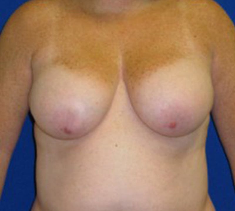 Mastopexy/Lift Before & After Gallery - Patient 175169317 - Image 1