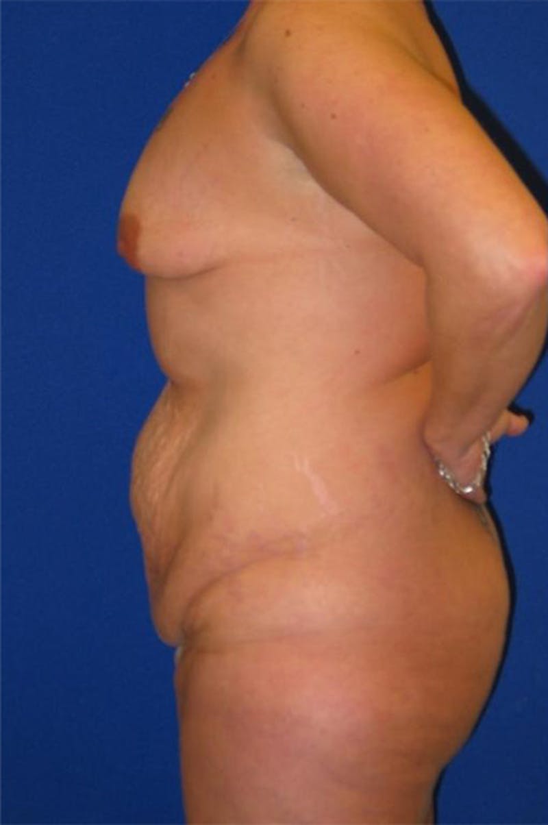 Extended Abdominoplasty Before & After Gallery - Patient 175169319 - Image 5