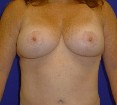 Mastopexy/Lift Before & After Gallery - Patient 175169317 - Image 2